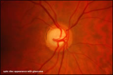 What the back of an eye may look like if you suffer with Glaucoma