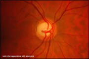 Glaucoma Awareness Week 8th - 14th March 2010