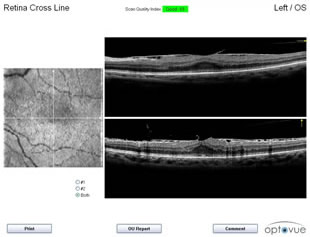 Macular cross section scan