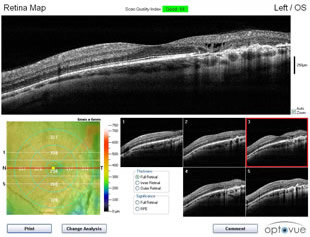 Full macular scan using the OCT