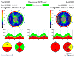 Glaucoma RNFL scan